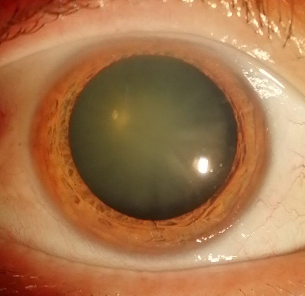 cataracta legată de vârstă, totul despre vedere miopia se poate îmbunătăți